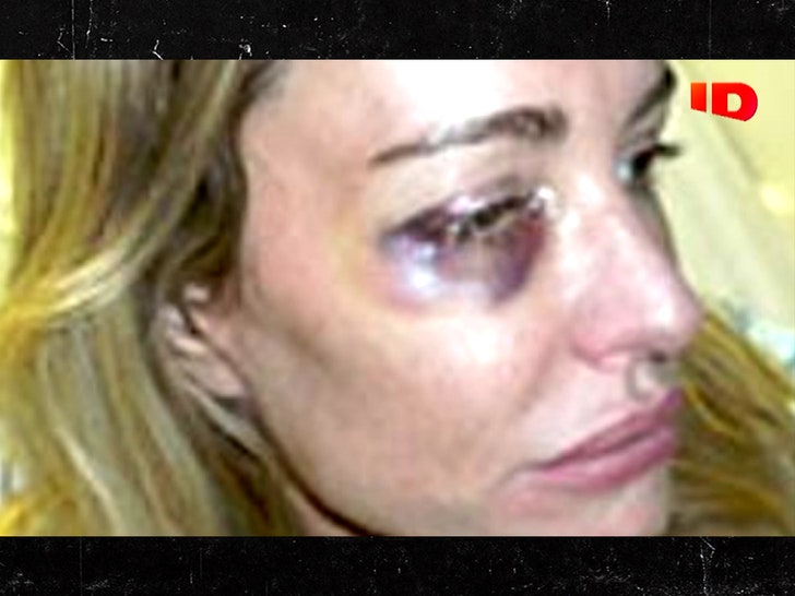 041425-taylor-armstrong-injury
