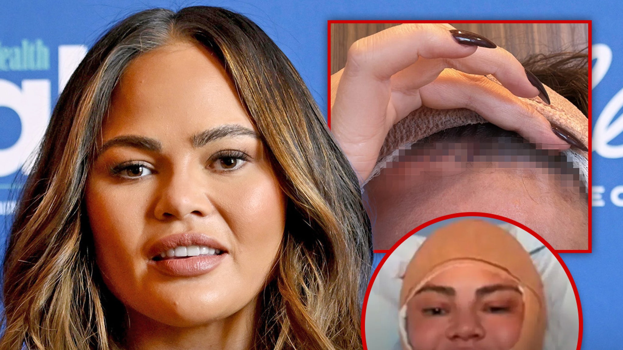 Chrissy Teigen Addresses Bandaged Face After Surgery