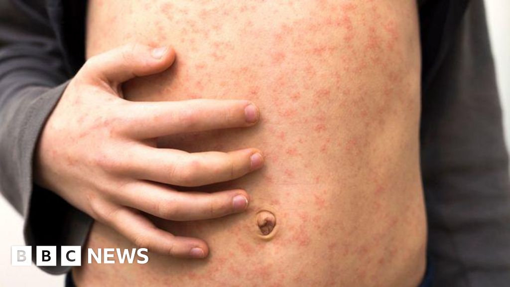 fa693460 42c3 11f0 93dd 9f3a34381ccc Measles warning to holidaymakers as cases rise across Europe