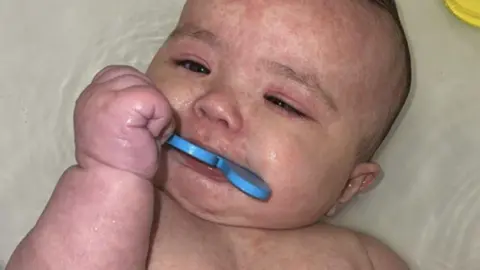 How Canada became the centre of a measles outbreak in North America Morgan Birch A photo of Kimie with a visible red rash on her body, a common symptom of measles.