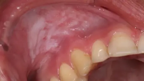 The rising use of nicotine pouches snus Sintija Miļuna-Meldere Oral mucosal changes caused by nicotine pouches