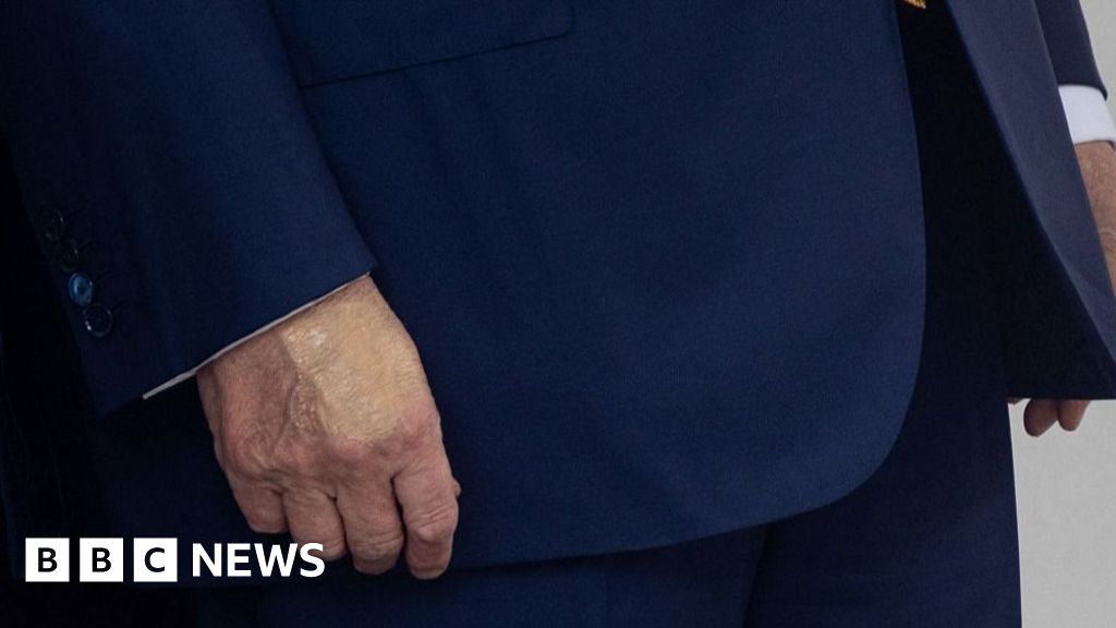 1d9f5ce0 6342 11f0 89ea 4d6f9851f623 White House says Trump diagnosed with vein condition