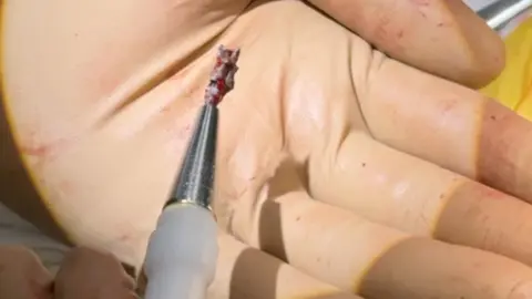 They took shrapnel out of my heart Dnipro cardiac center The shrapnel that was in Serhiy's heart attached to the magnetic extractor that removed it.