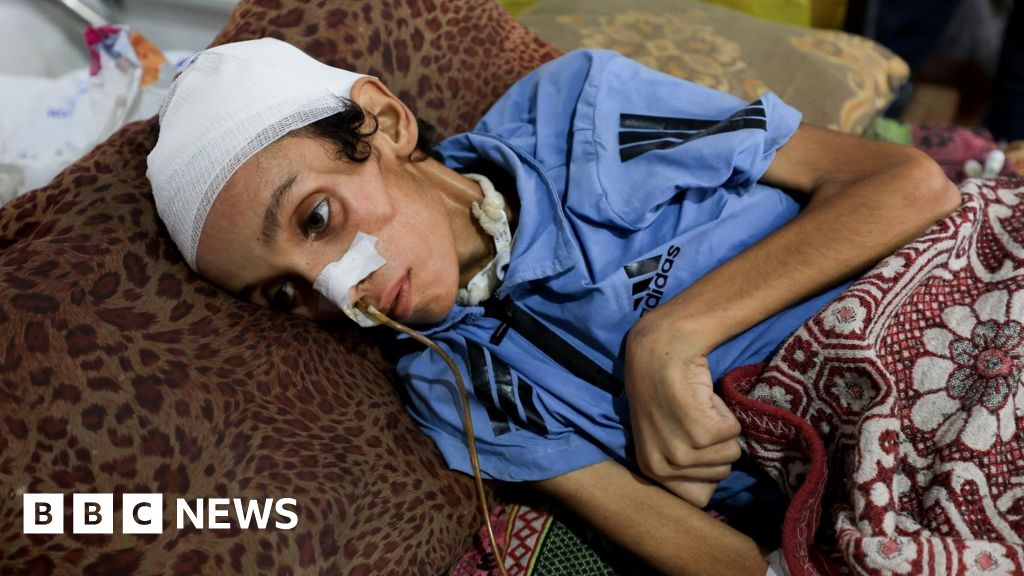 25b85fb0 679a 11f0 af20 030418be2ca5 One in five children in Gaza is malnourished, UN aid agency says