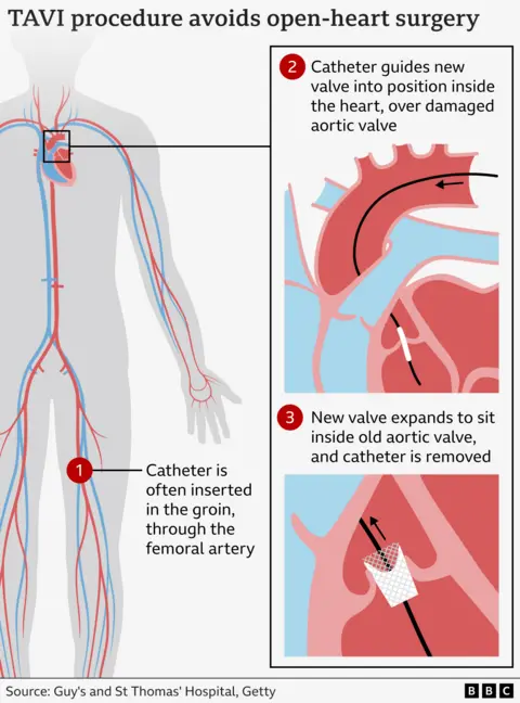 'Hospital gave us two death certificates for dad to cover up their mistake' Graphic illustrating how the TAVI procedure works by inserting a new valve via a catheter through a blood vessel.