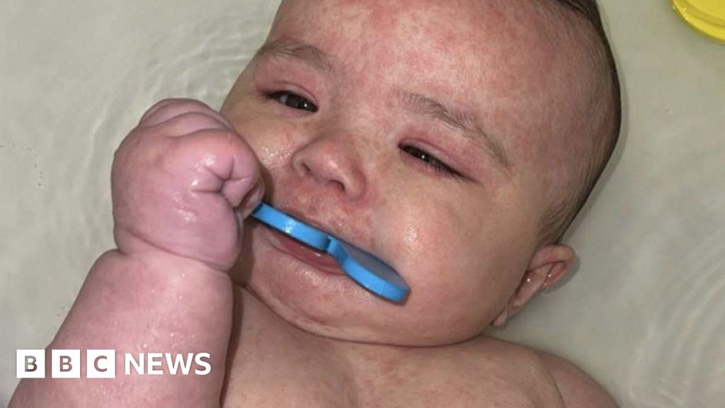 dd1fcb20 63ee 11f0 af20 030418be2ca5 How Canada became the centre of a measles outbreak in North America