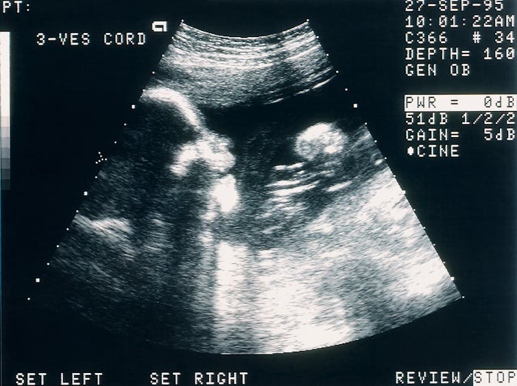 Black and white sonogram of a human fetus