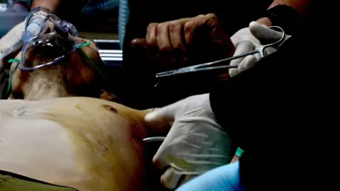 Inside Donetsk as residents flee attacks on Ukrainian region Putin wants to control BBC News A man is lying topless, wearing a breathing mask, as a pair of hands holding pliers appears to stitch up a wound under his armpit