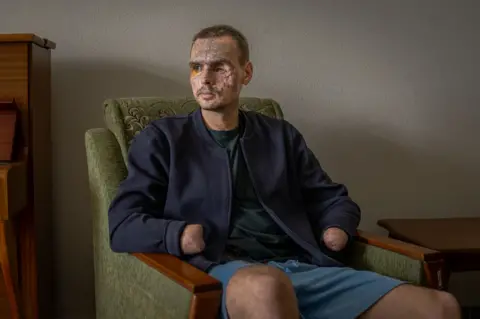 They escaped Ukraine's frontlines. The sound of drones followed them Nazar Bokhii sits in a green chair wearing a dark blue jacket and light blue shorts, his face scarred by an explosion