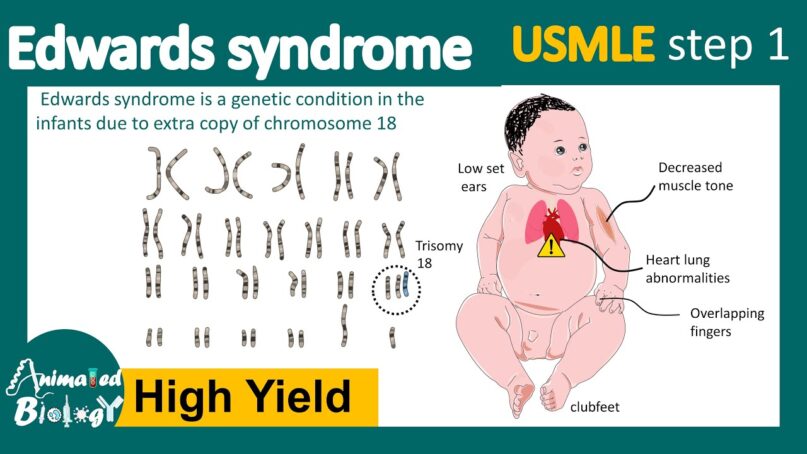 Trisomy 18 pic Recalling one of the most difficult decisions a family can make
