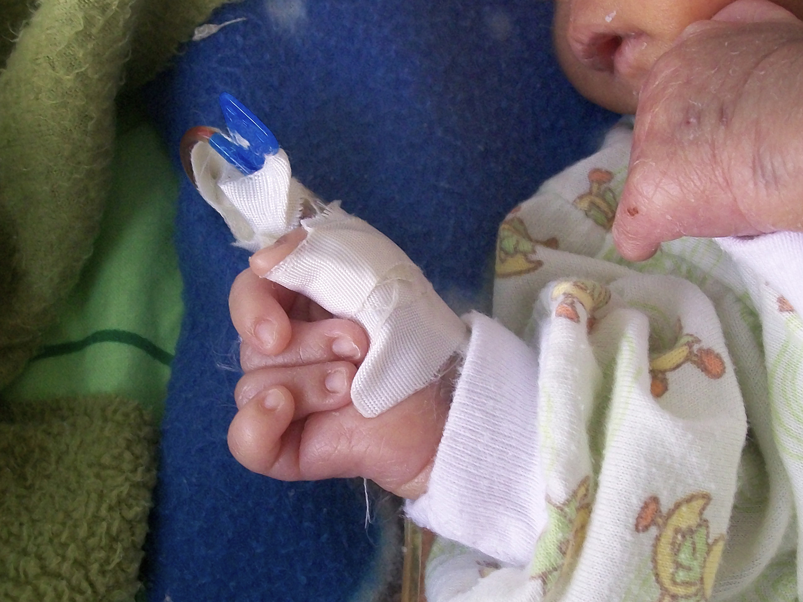 webRNS Trisomy 18 Recalling one of the most difficult decisions a family can make