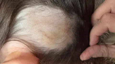 Mum's warning after Temu brush rips out child's hair Supplied A three-year-old girl sits on a grey seat, revealing a 10cm square bald patch on her scalp, surrounded by her natural brown hair. The skin is bruised and red.